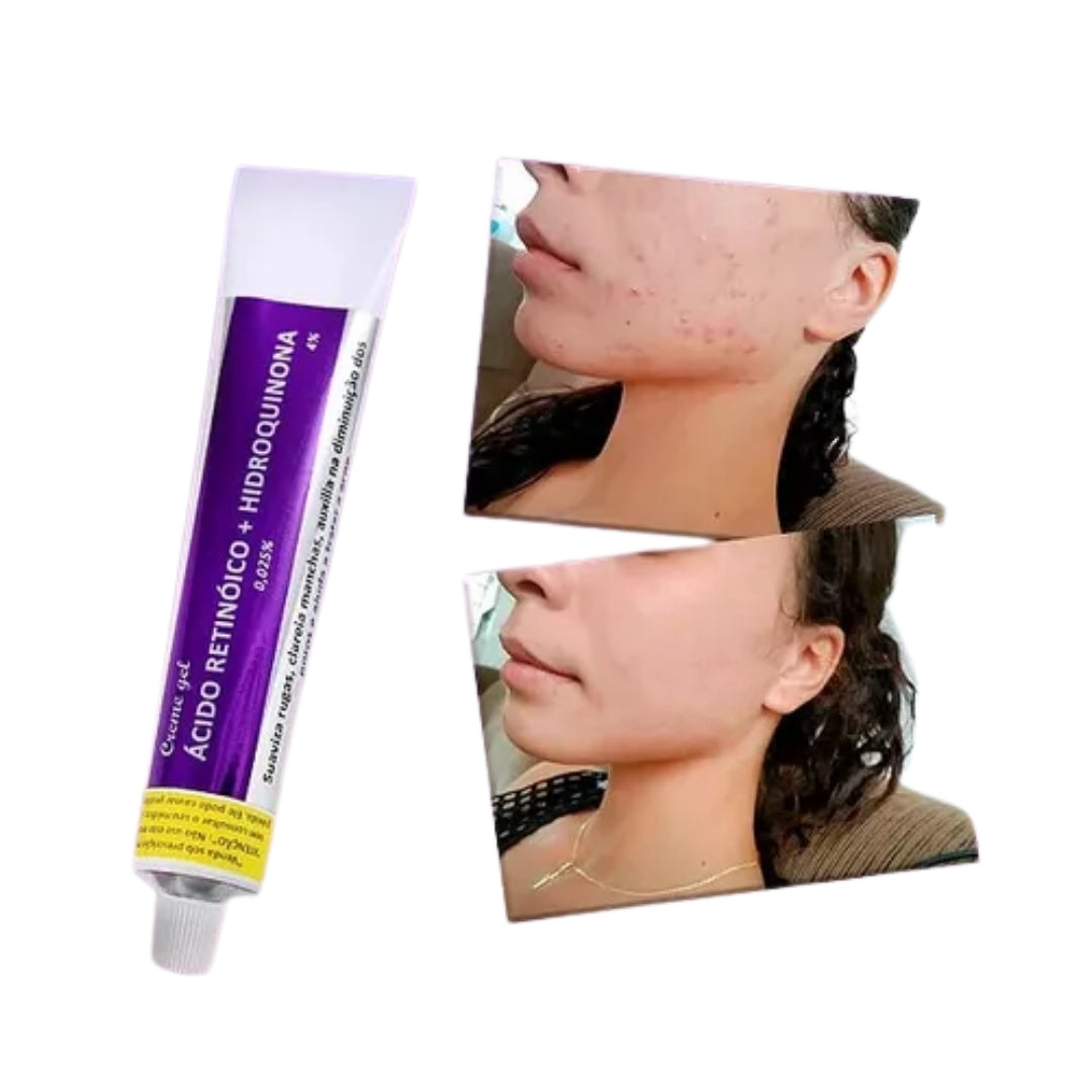 Melasma Lightening Facial Peeling Retinoic Acid + Hydroquinone Gel 30g Belladona